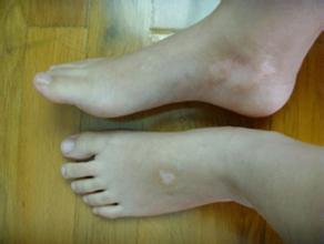 腿部白癜风有哪些要注意的呢 腿部白癜风有哪些要注意的呢.jpg