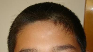 颈部出现白斑为什么会发痒 颈部出现白斑为什么会发痒.jpg