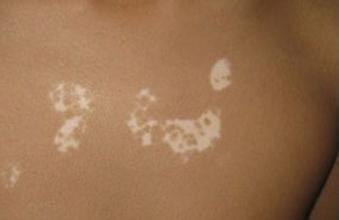 青少年白癜风患者怎么进行心理治疗 青少年白癜风患者怎么进行心理治疗.jpg