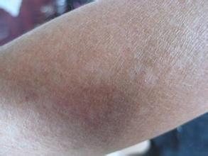 白癜风的初步诊断方法是什么 白癜风的初步诊断方法是什么.jpg